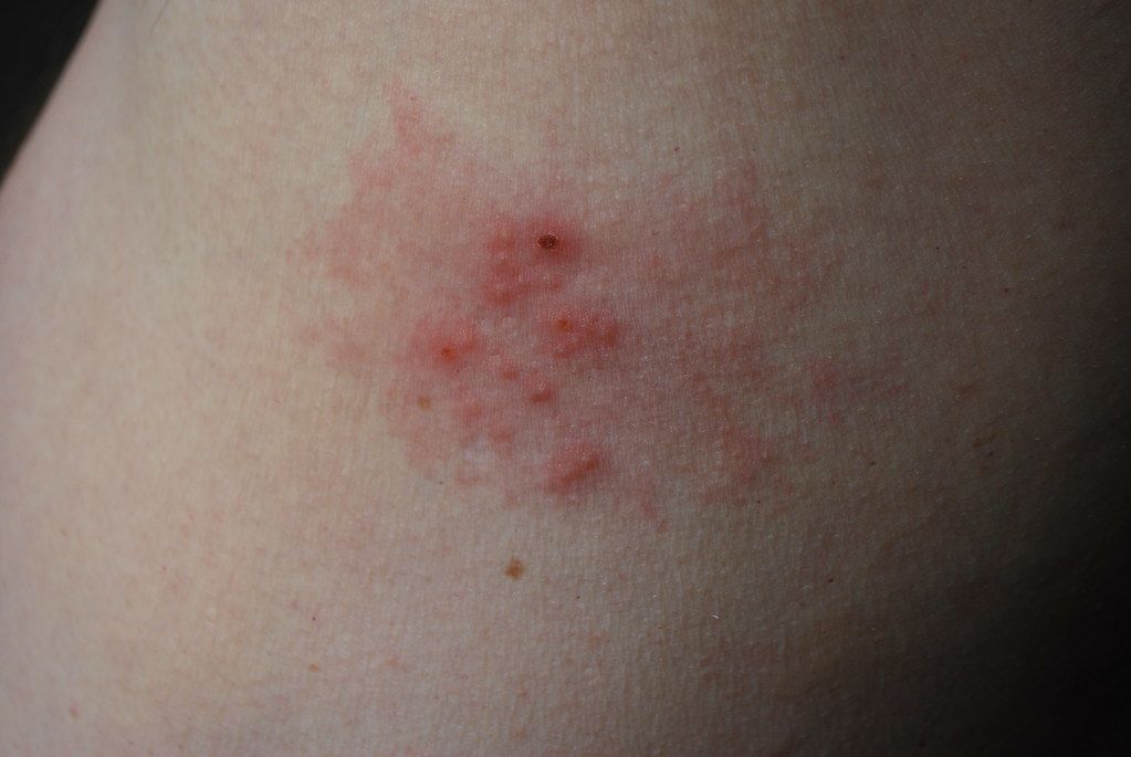 Eat Your Way to Shingles Recovery: Fact or Fiction?