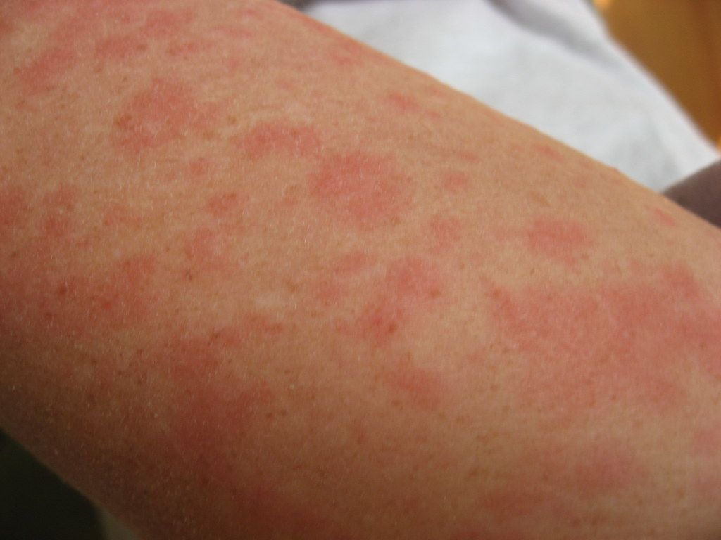 The Straight Talk Guide to Conquering Hives