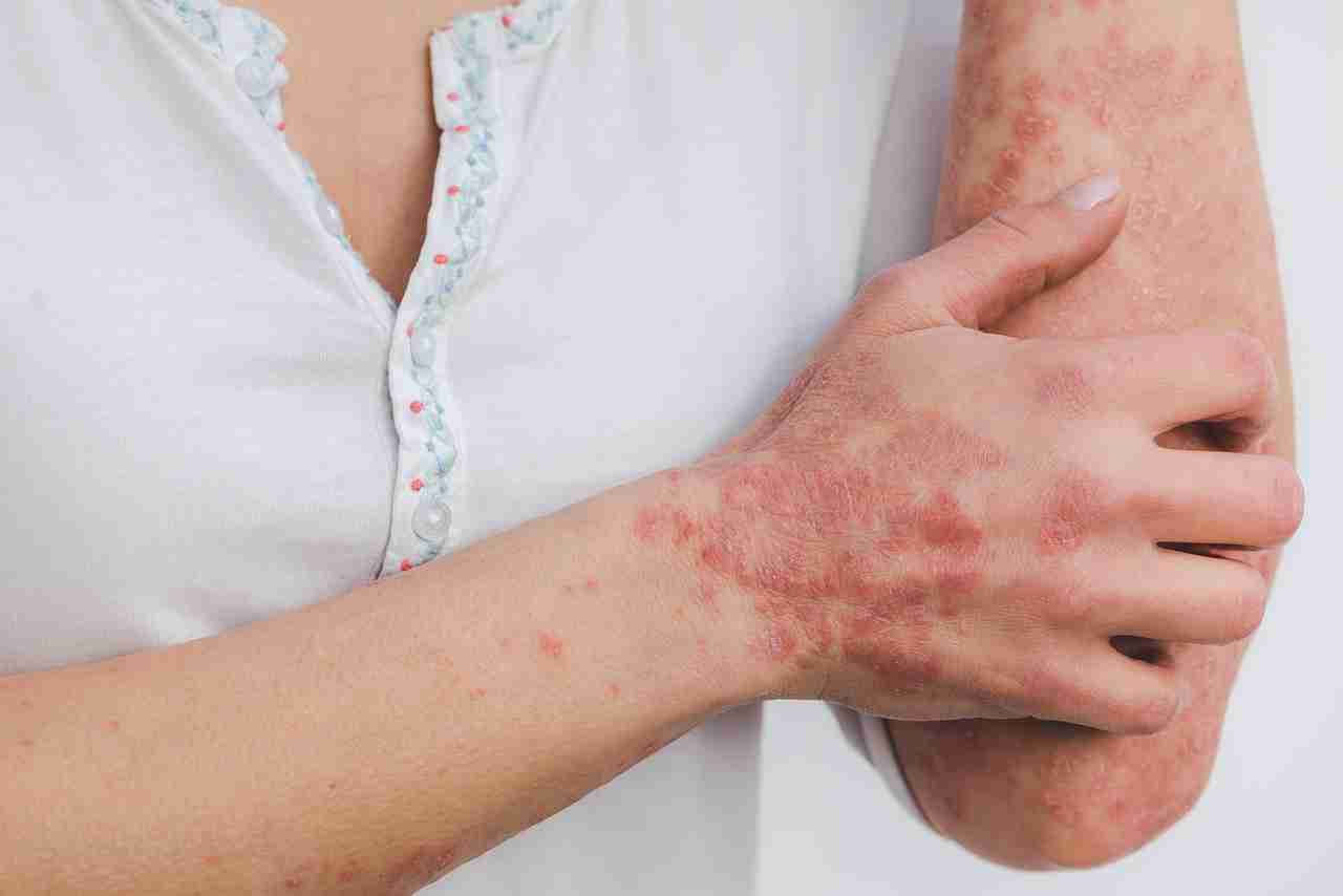 The Brutal Truth about Psoriasis Soaps You Need to Hear