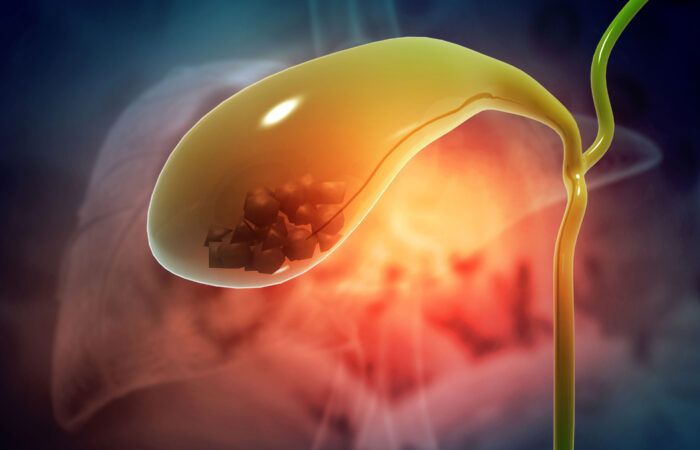 Grumpy Gallbladder: Signs, Sighs & Solutions