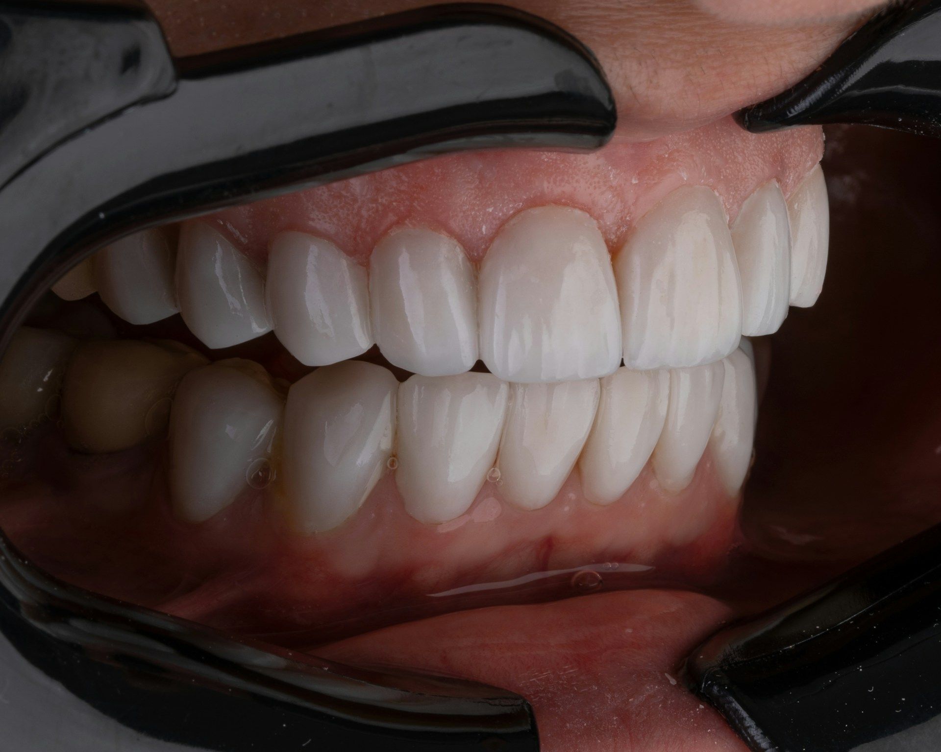 Understanding the Grinder: Bruxism Unravelled