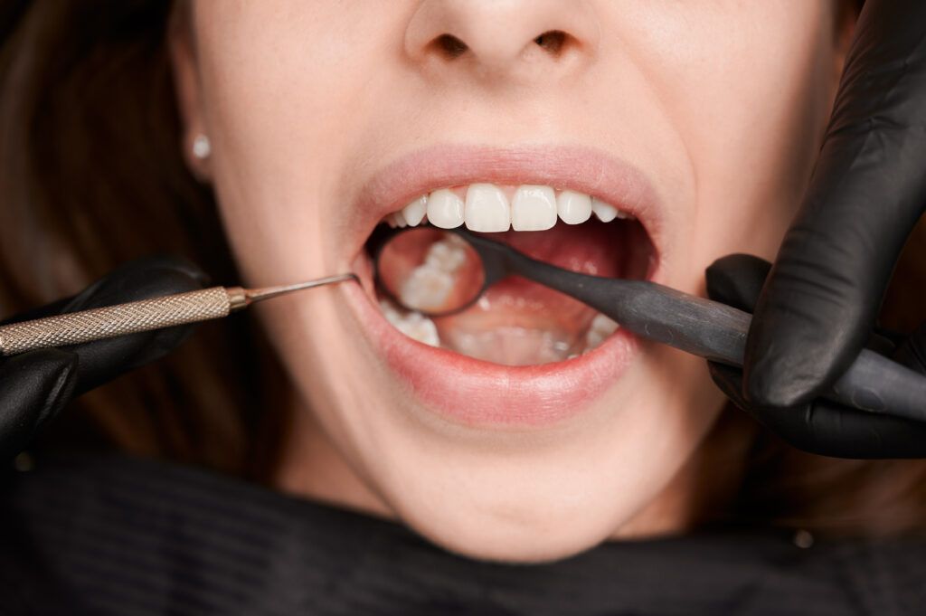 The Ugly Truth About Cavities: Decoding Dental Decay