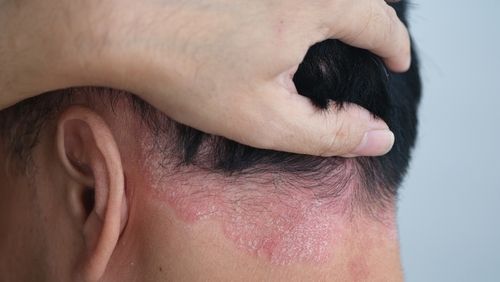 Itchy Scalp Troubles: The Bane of Your Existence? Let's Scratch That!