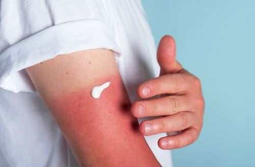 Sunburn SOS: No-BS Natural Ingredients to Quench the Fire