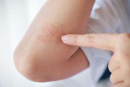 Unleashing the Power in Your Pantry: How Your Diet Could Impact Psoriasis