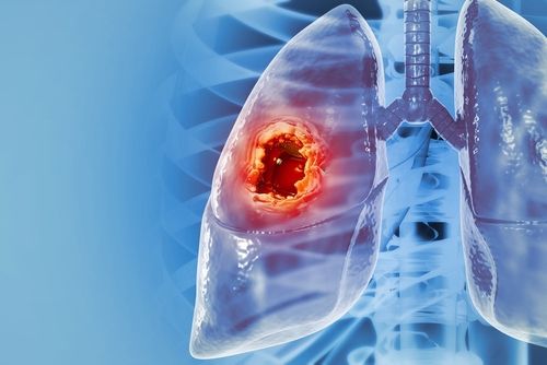 Kiss Lung Cancer Goodbye: Decoding Brain Metastasis